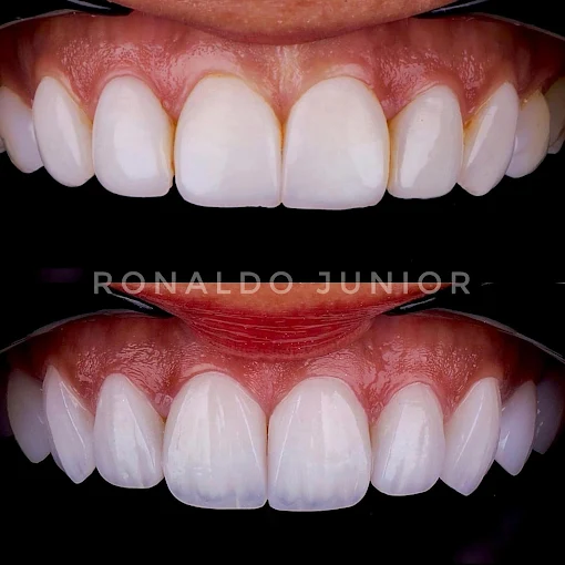 Resultado de tratamento estético — antes e depois